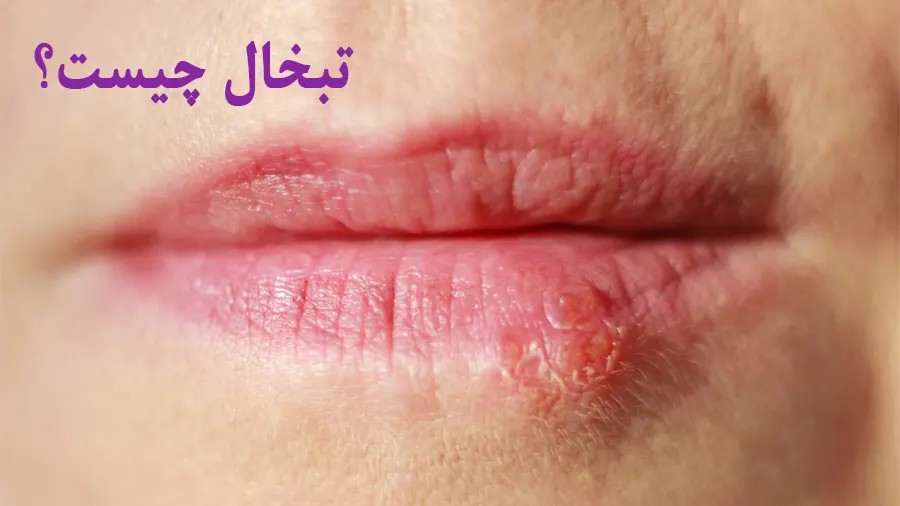 دانلود تبخال چیست؟ رایگان دانلود تبخال چیست؟ رایگان