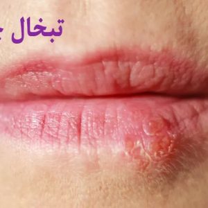 انواع تبخال: تشخیص علائم و راههای درمان انواع تبخال: تشخیص علائم و راههای درمان