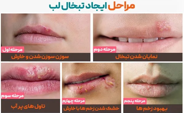 دانلود علت‌ها و عوامل تحریک‌کننده تبخال رایگان